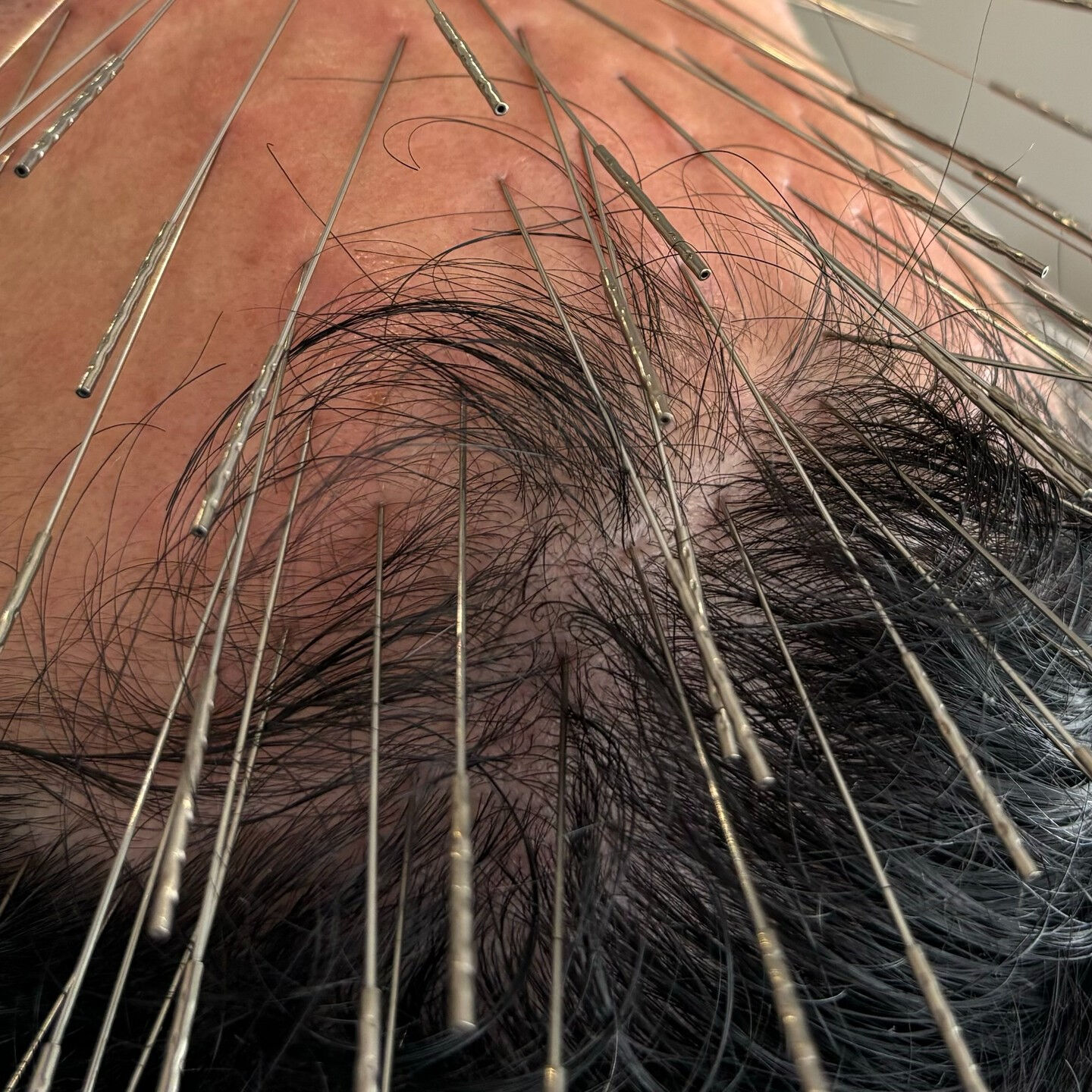 ルート薄毛治療について