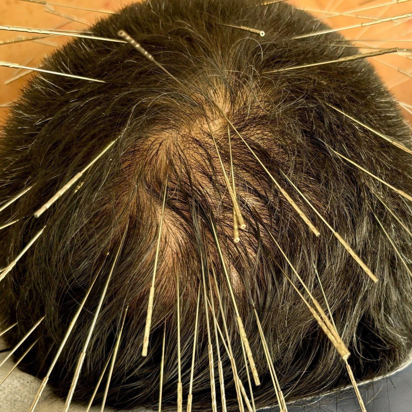 ルート薄毛治療について