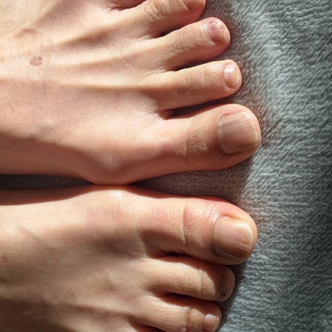 患者さんから写真と経過報告いただきました