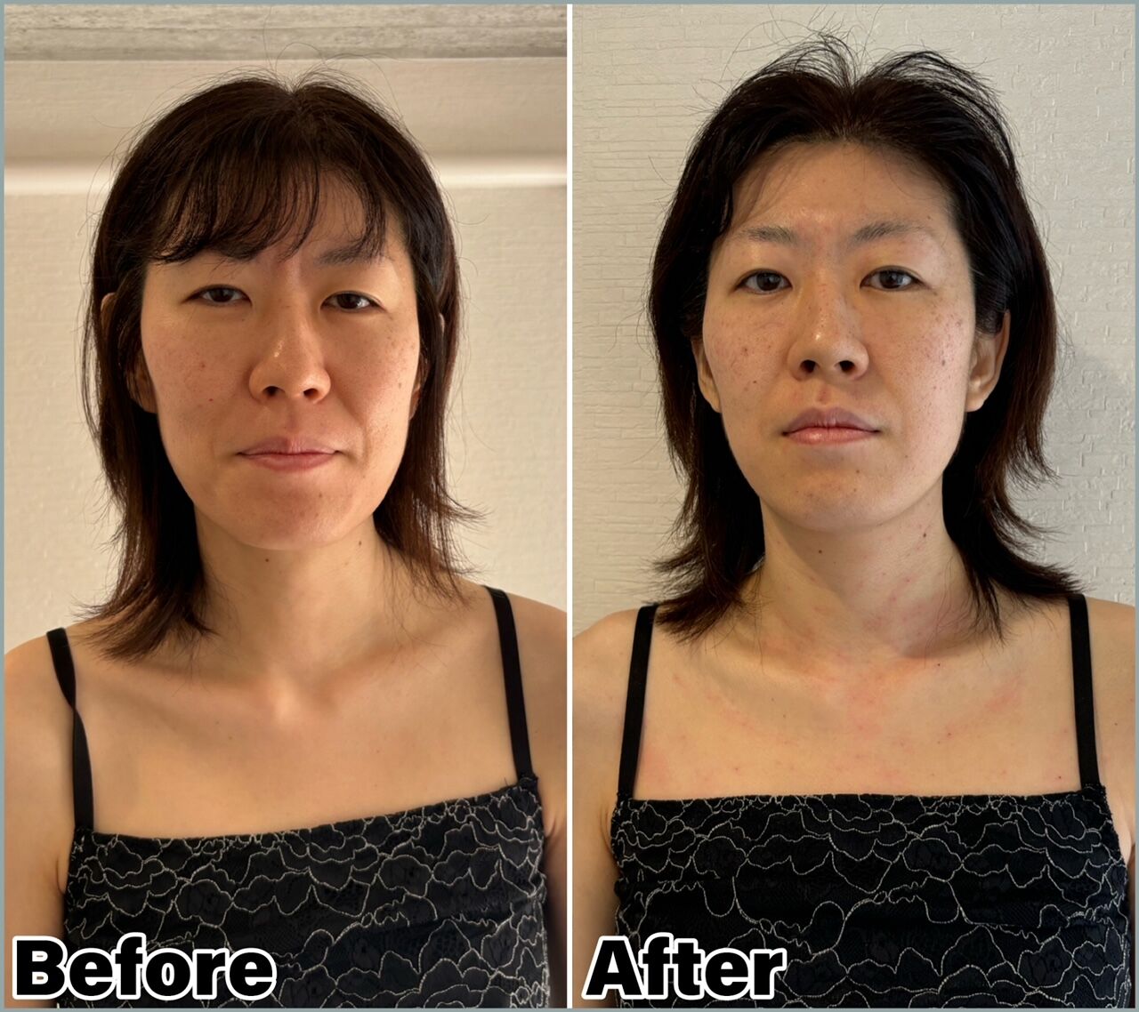 お顔も姿勢も変化がありました！　ルート治療＋鬼美容鍼＋お灸　９０分の施術