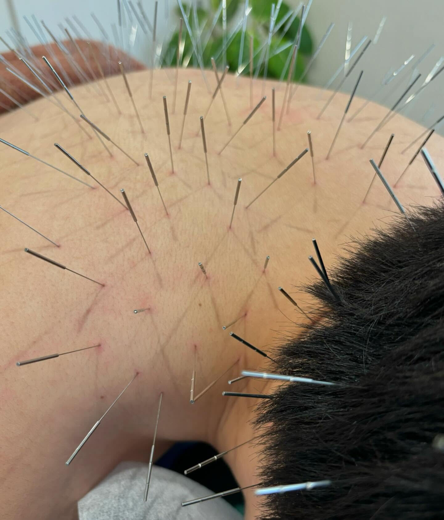 本日は、初めて鍼治療を受けられる患者さんがご来院くださいまし