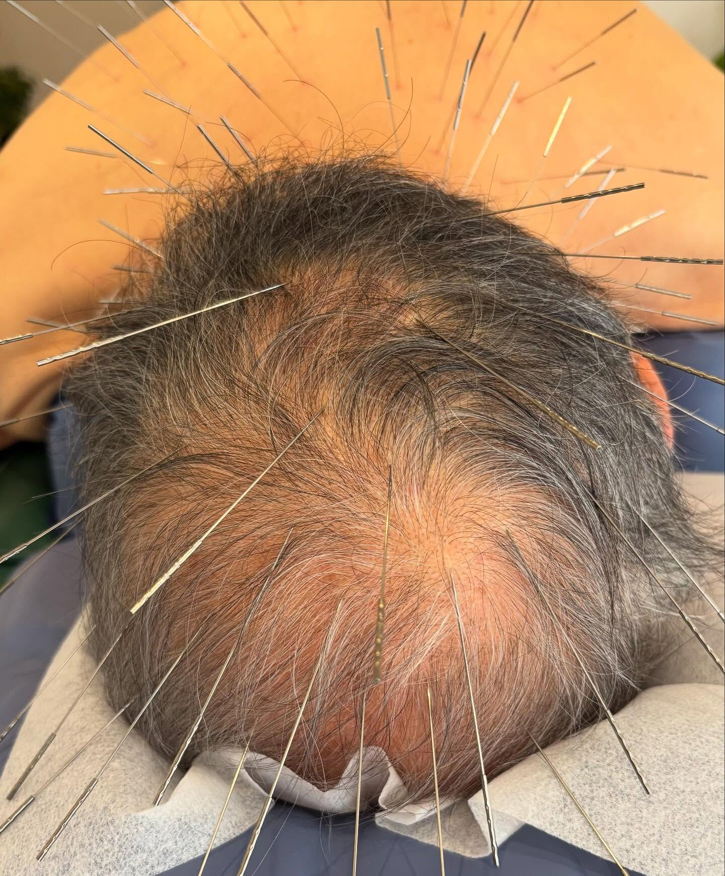 初めてお越しいただいた患者様にルート治療を行いました