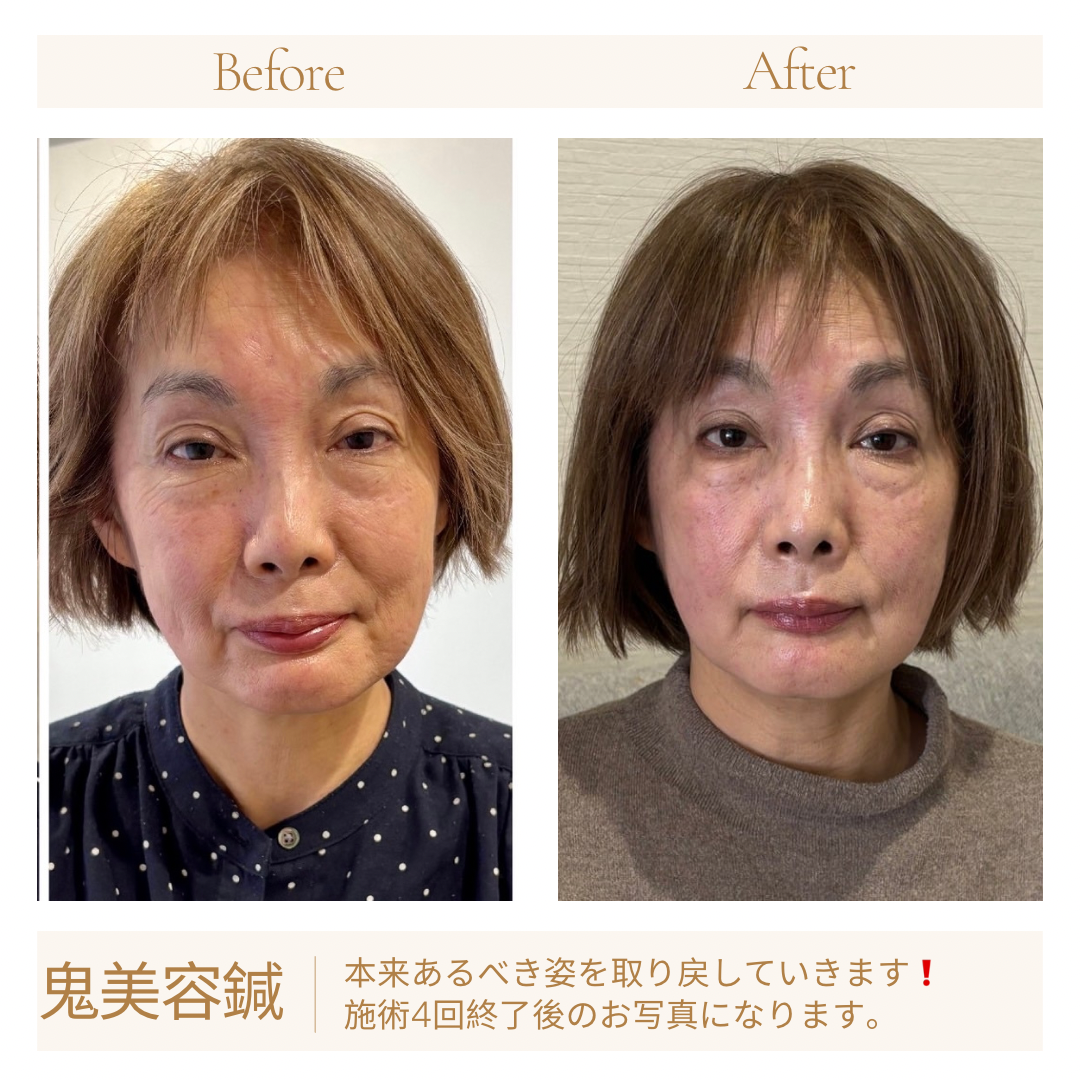 ☆【鬼美容鍼】と【電気鍼】を併せた美容鍼で若々しい表情へ☆