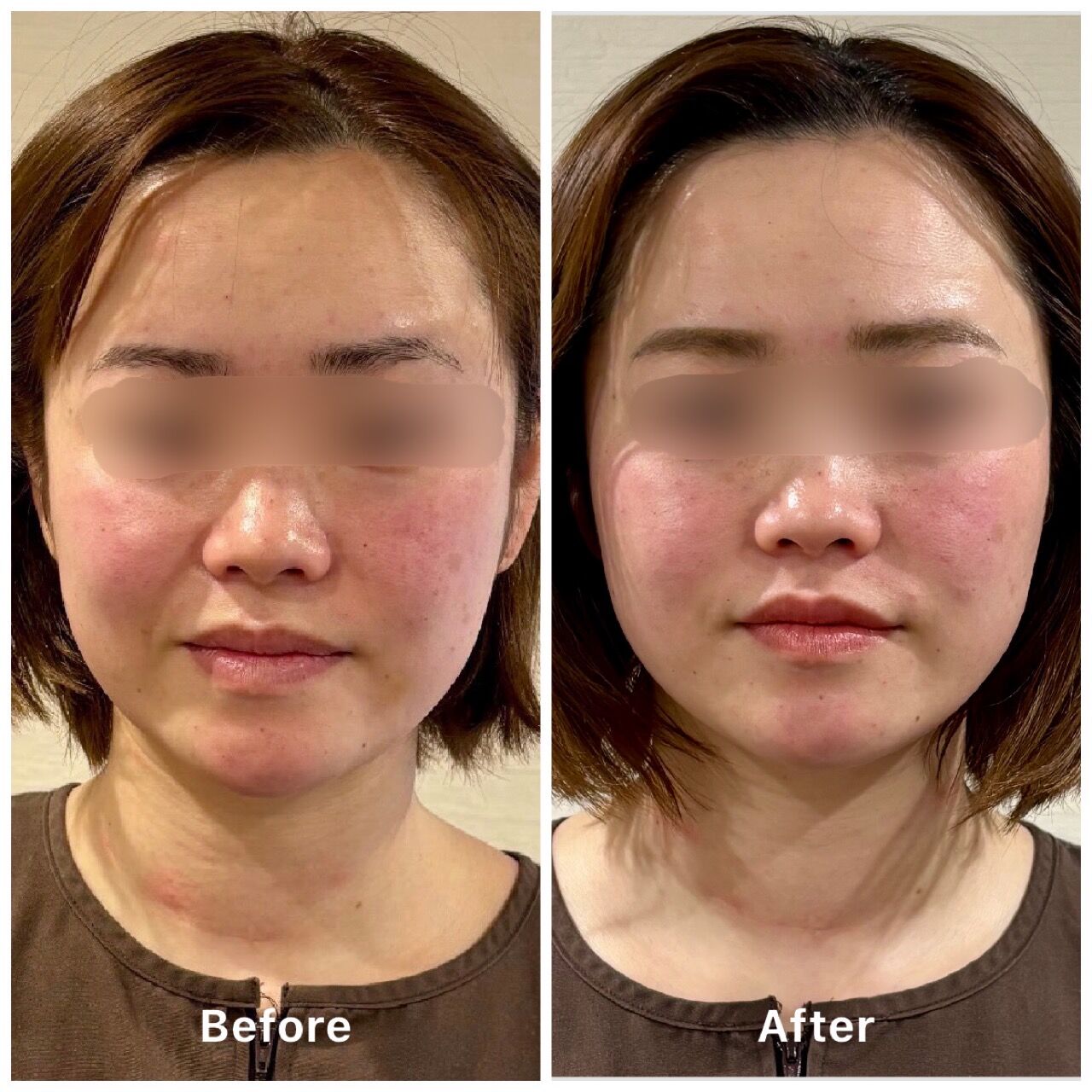 ３０代後半から気になる　お顔のコケや疲労感にお悩みの方へ