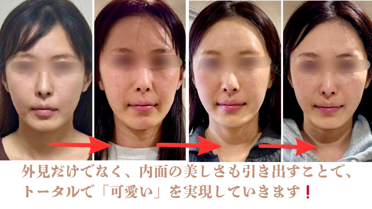 【☆初回限定30％OFF】　あなた本来の輝きを引き出す、美容鍼で新しい自分に出会いませんか？　施術3回　33,000円→23,100円