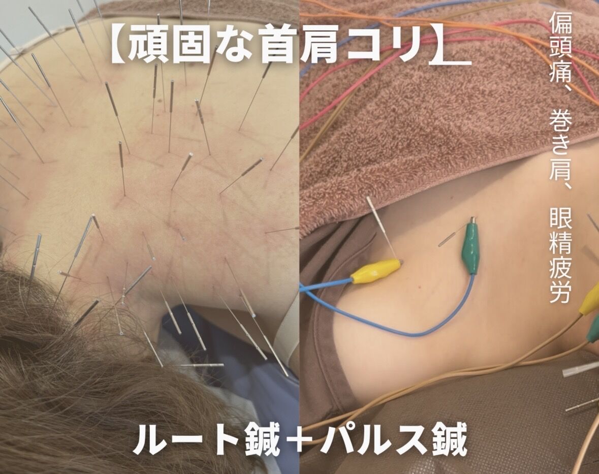 デスクワークやエアコン冷えで「首肩がガチガチ」な方へ！ルート鍼とパルス鍼（電気鍼）で重いコリを根本ケア