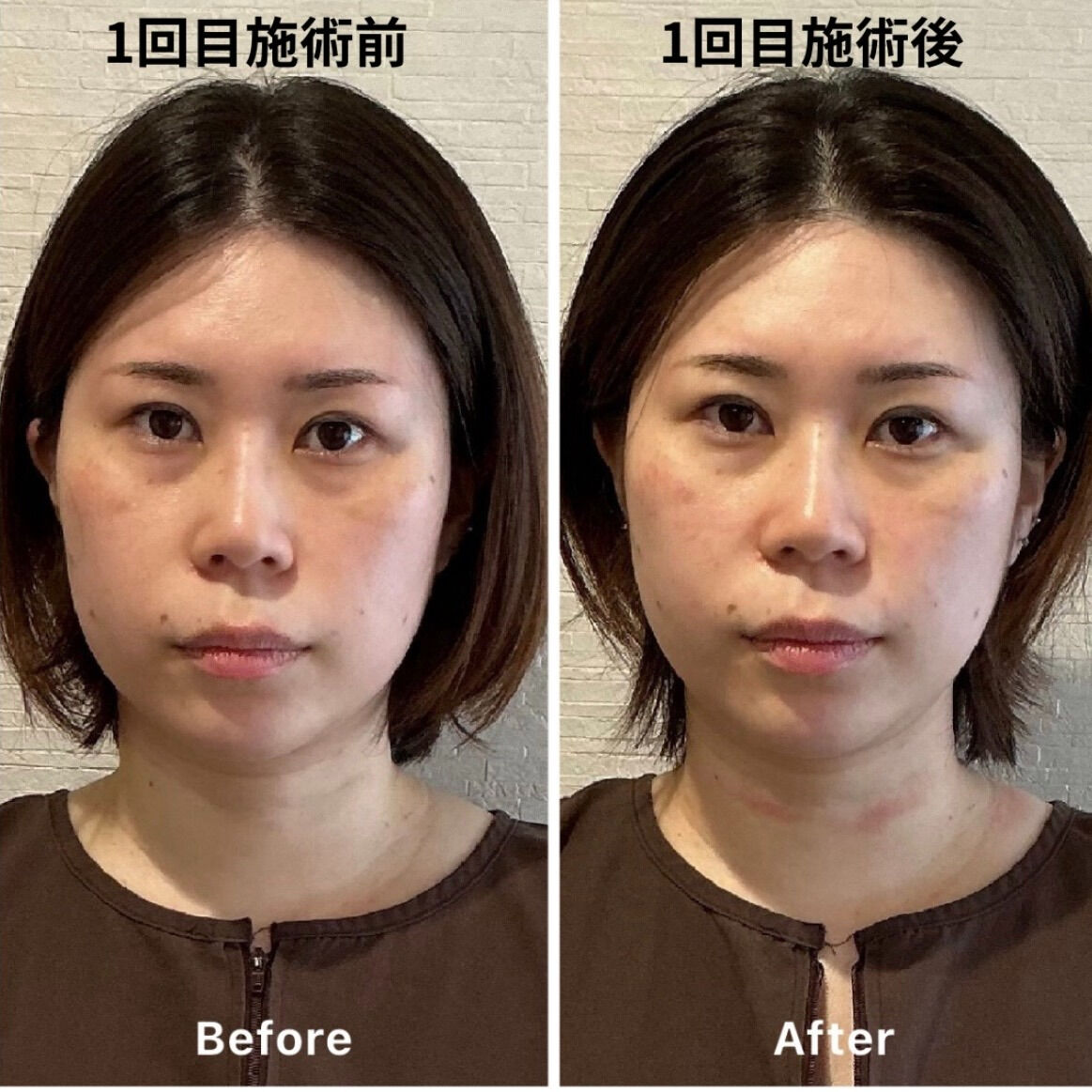 ✨美容鍼3回での変化！✨