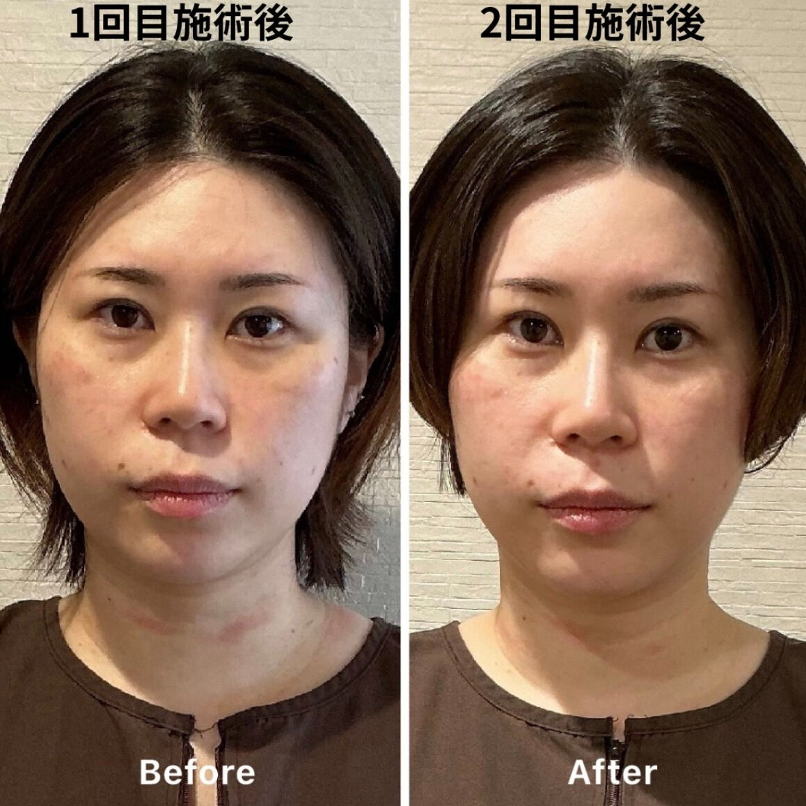 ✨美容鍼3回での変化！✨