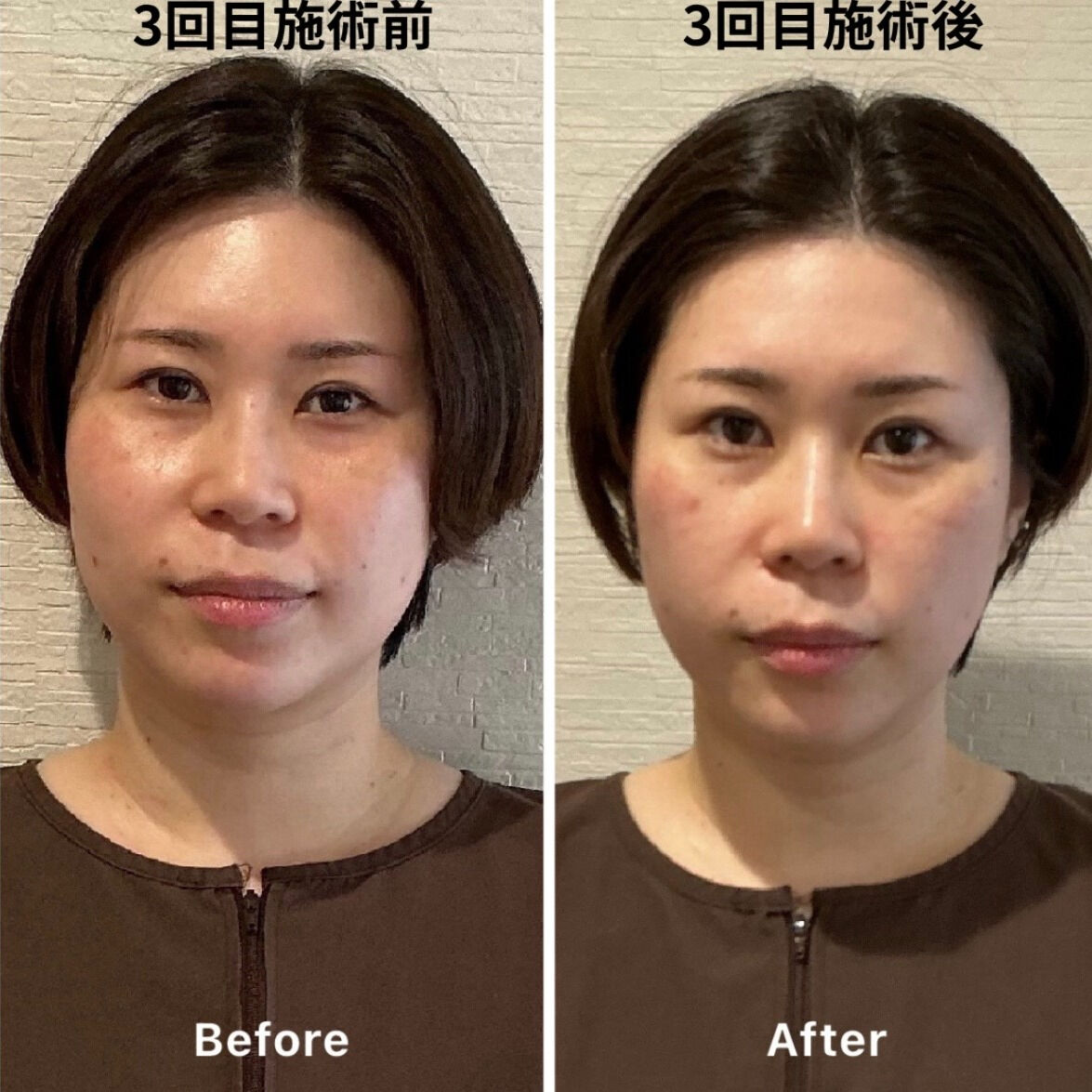 ✨美容鍼3回での変化！✨