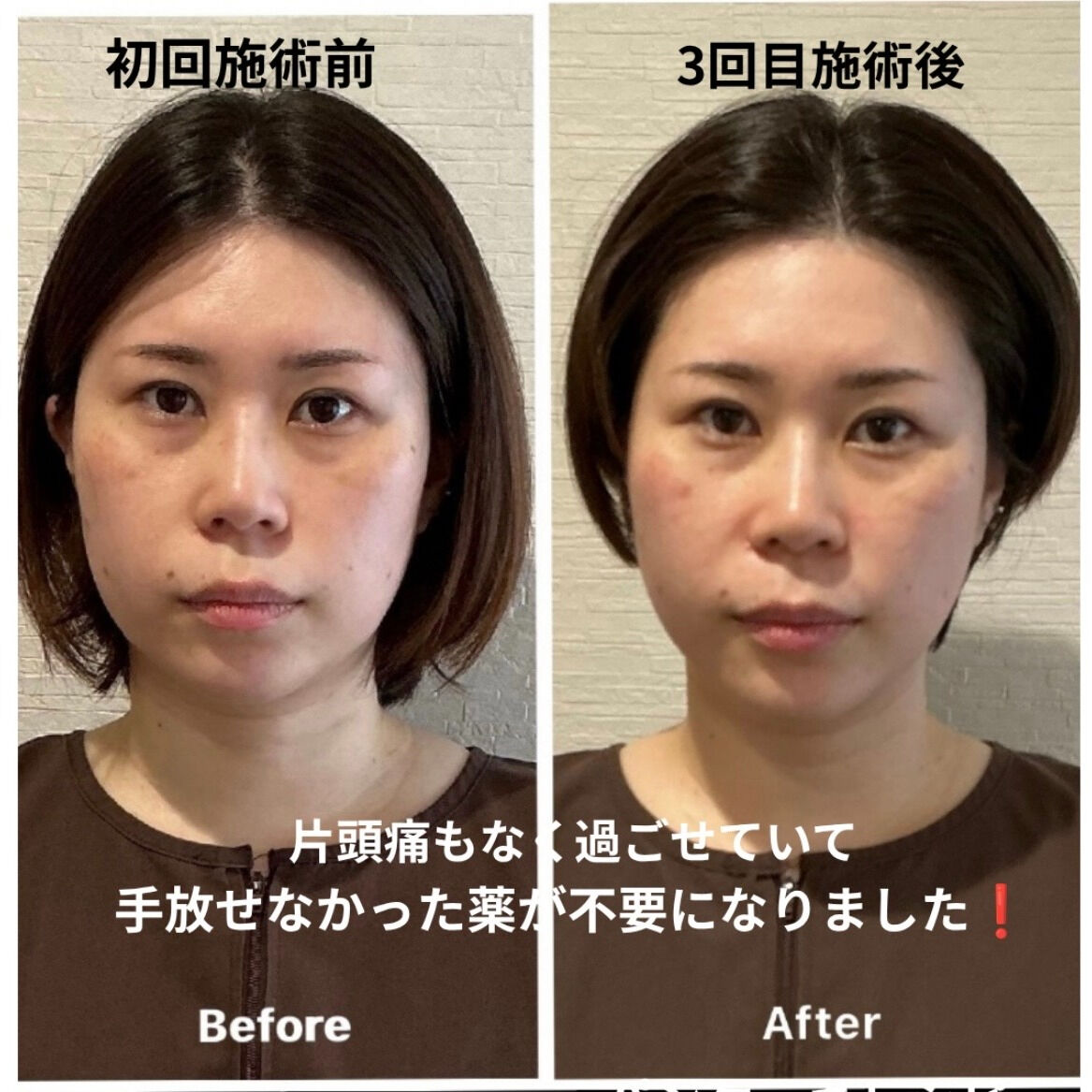 ✨美容鍼3回での変化！✨